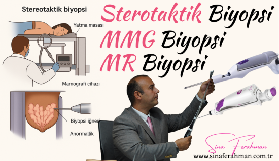 Mammografi (MMG) veya MR ile Vakum Biyopsi (Vakum Destekli Meme Biyopsisi) Bilinmesi Gerekenler