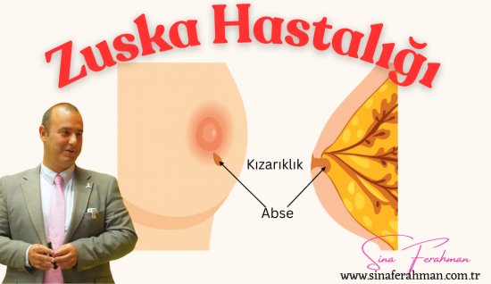 Zuska Hastalığı Nedir? Bilimsel Gerçekler
